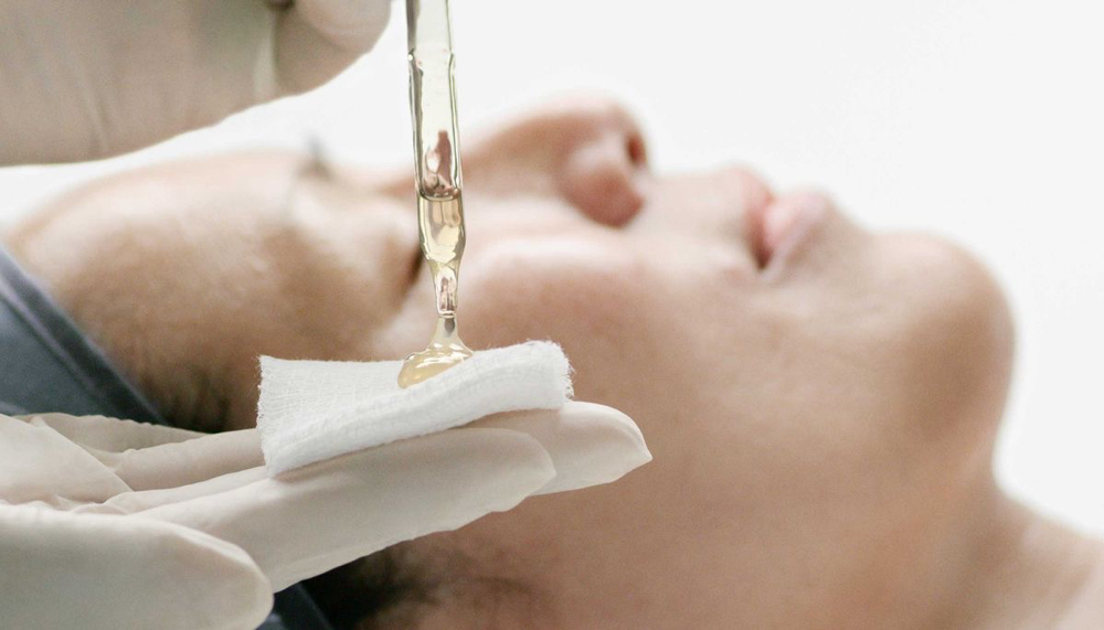 Chemical Peel