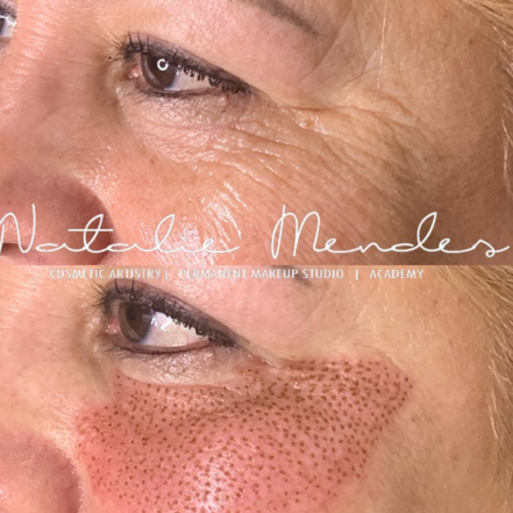 Plasma lift at Cosmetic Artistry in Lancaster, CA