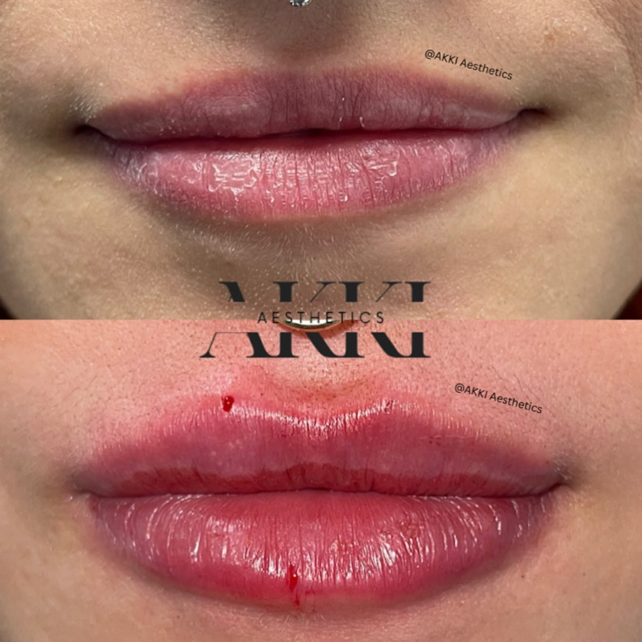 Lip Filler (1ML) at Akki Aesthetics in Williston Park, NY