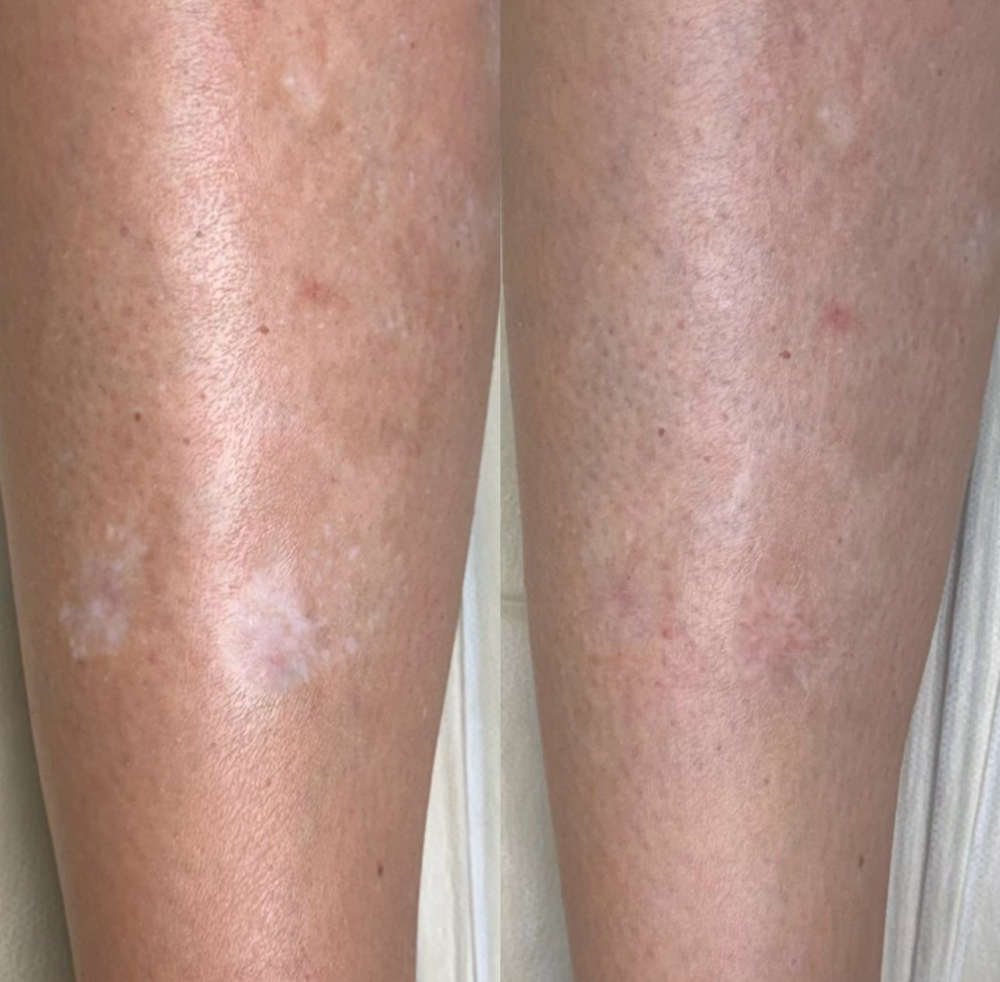 Scar/vitiligo Camouflage