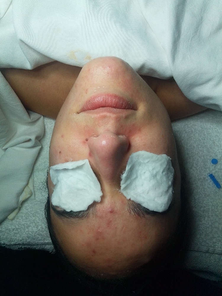 Acne Facial