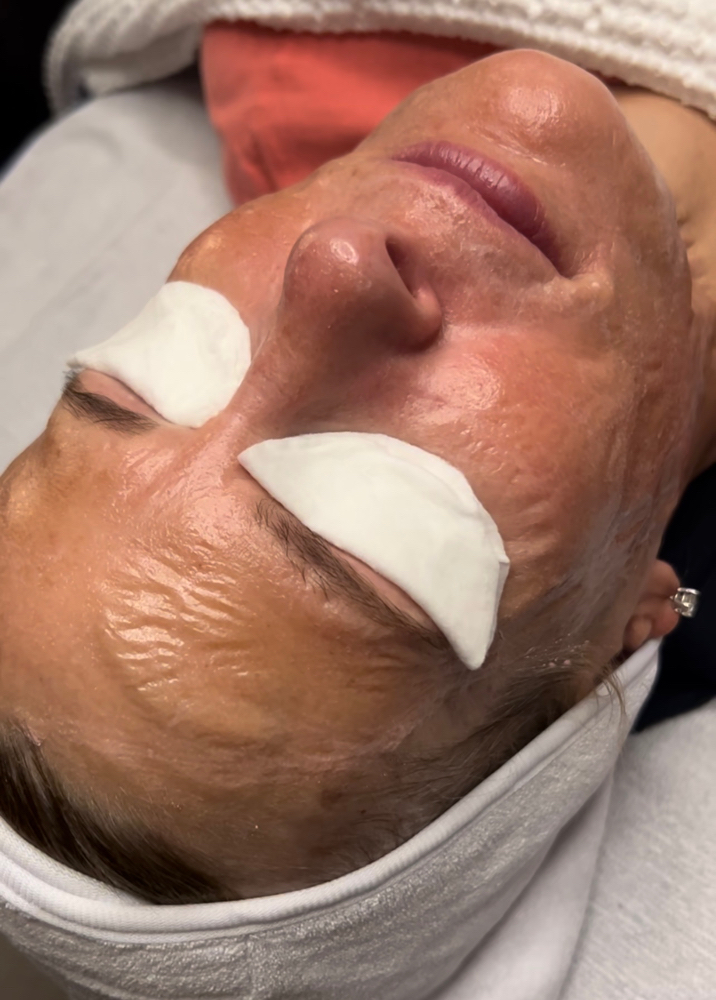 V Tox Lift Facial