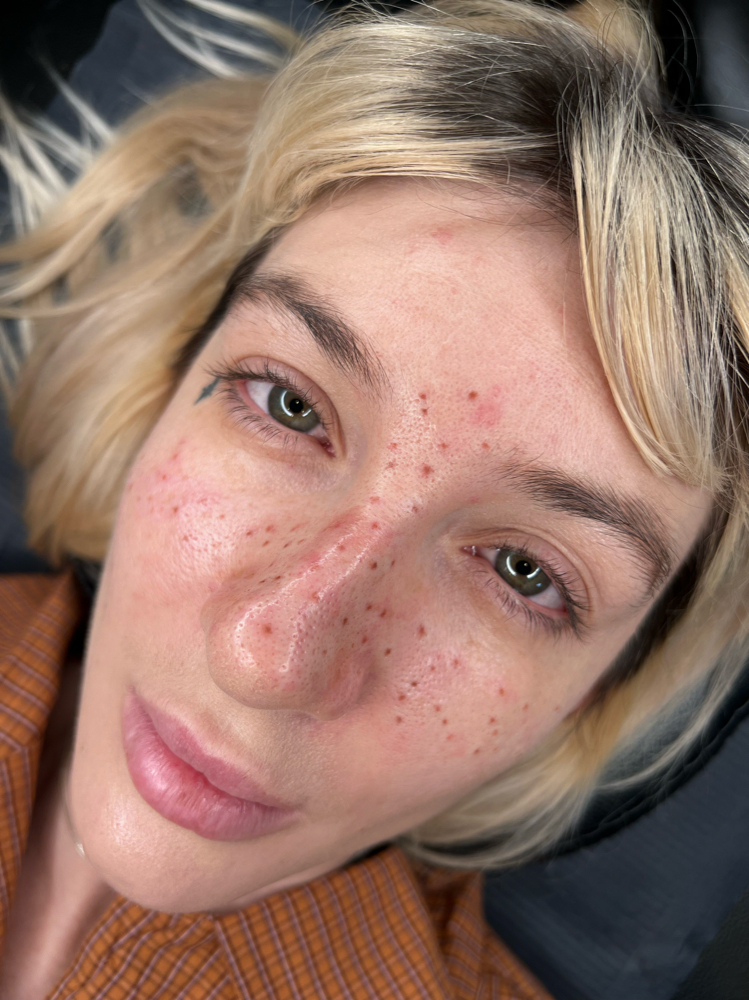 Freckles