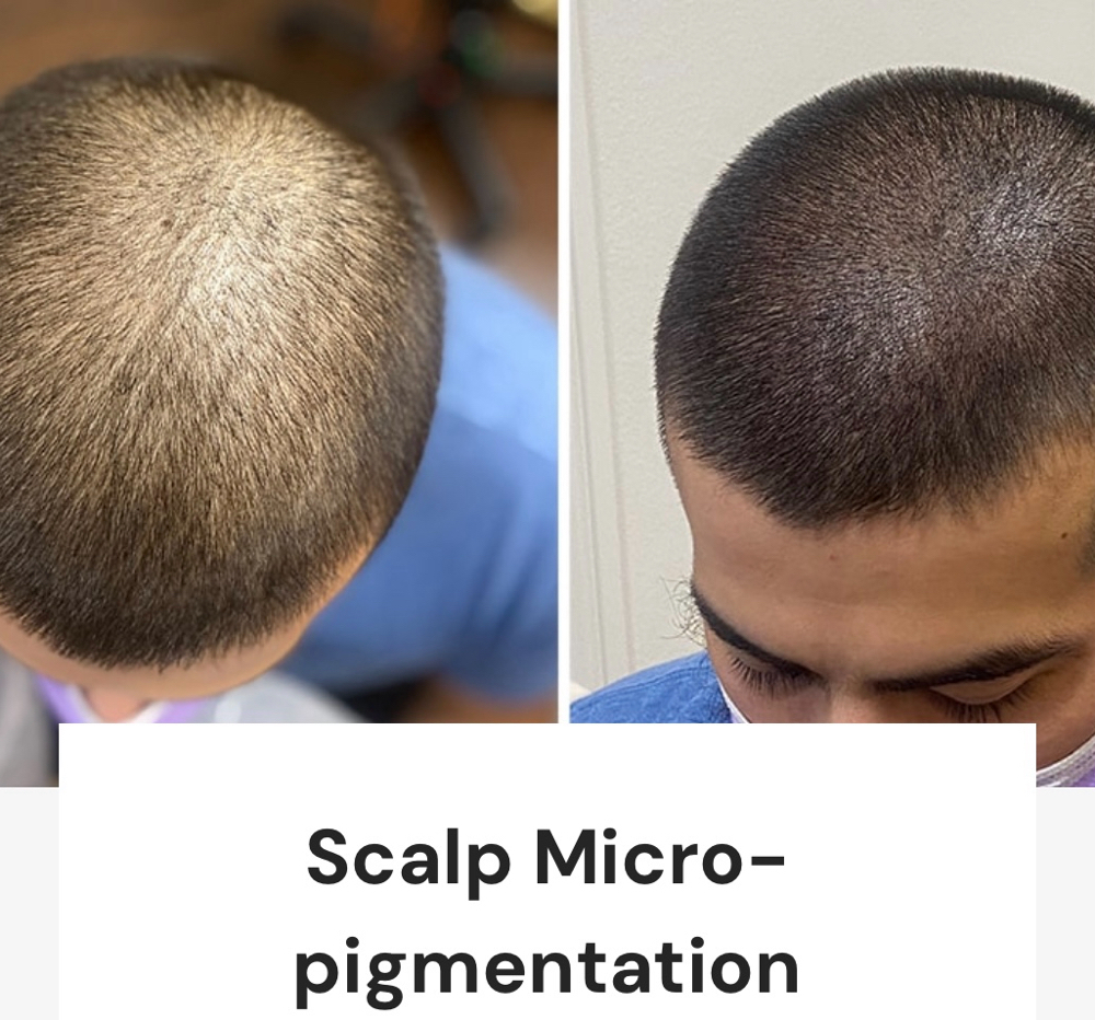 Scalp/Beard Micropigmentation