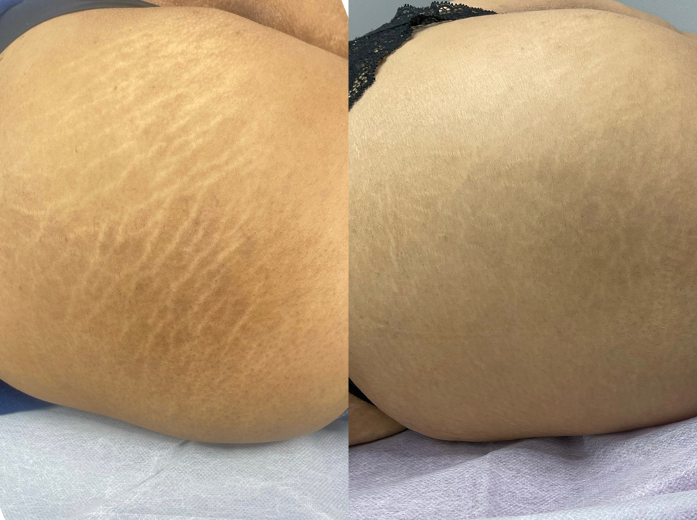 Inkless Stretch Mark Revision