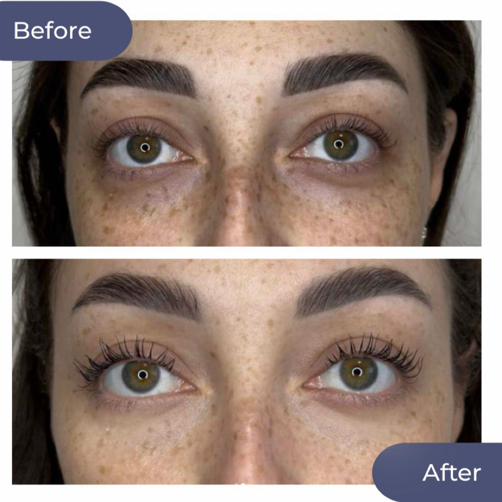 ❤️Promo Under Eyes PDRN❤️ at Lips by Katrin in Coconut Grove, FL