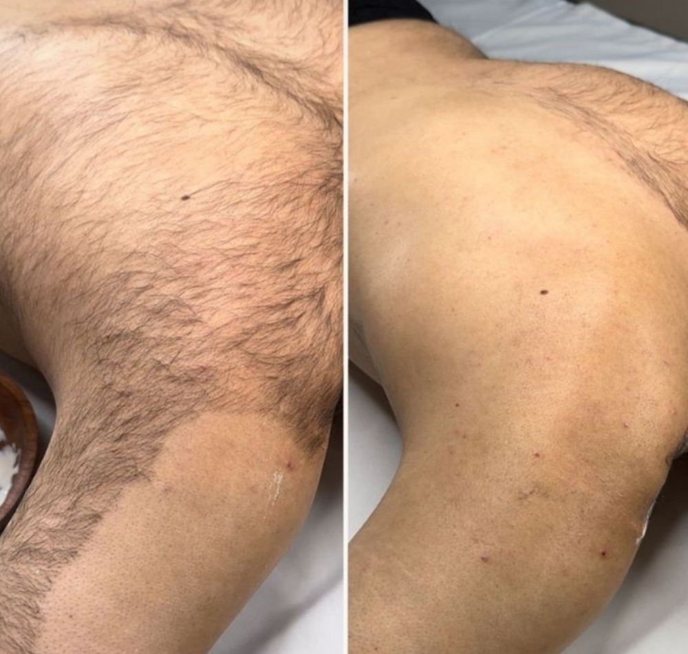 Back Wax Hair Removal