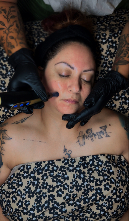 Nano Needling/Oxygen Therapy