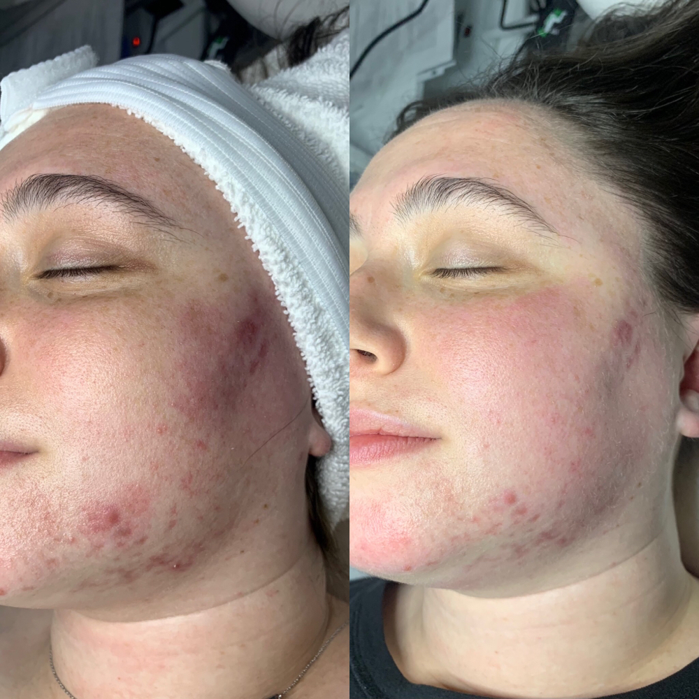 Acne Facial