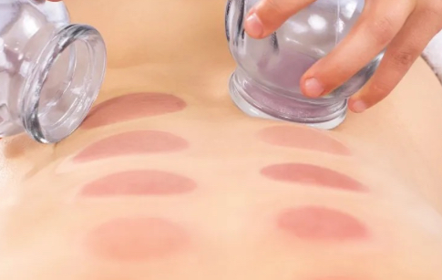 Dry Cupping
