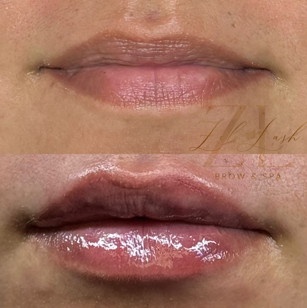 Lip Filler Half 💉