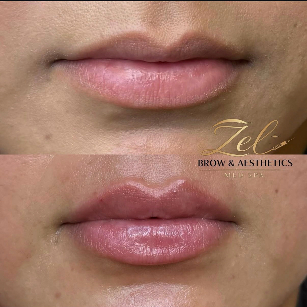 Lip Filler Half 💉 at Zel Brow & Aesthetics Med Spa in Thornthon, CO