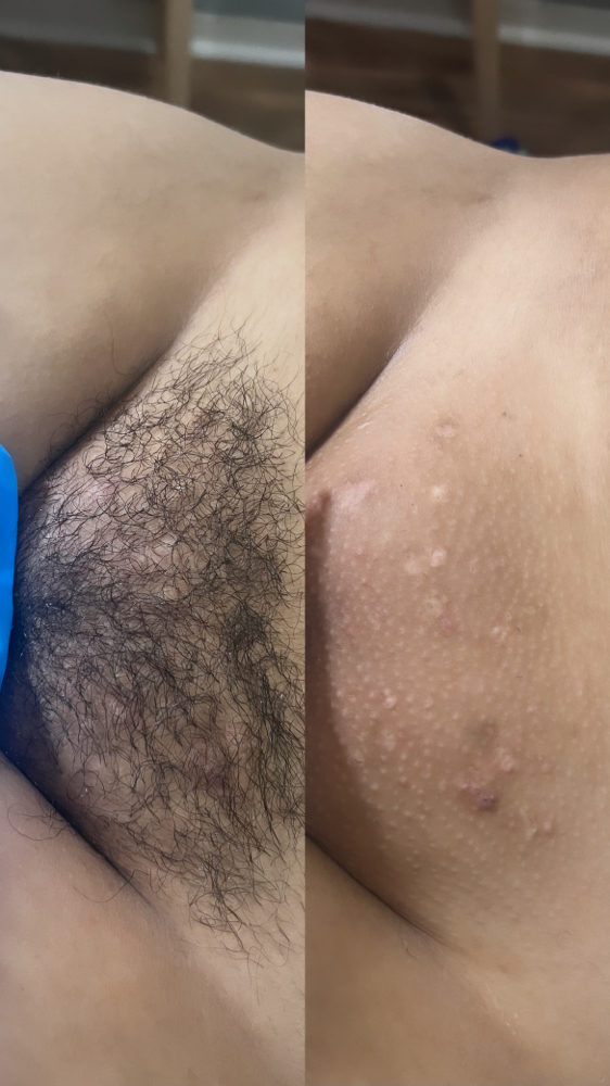 Brazillian Wax