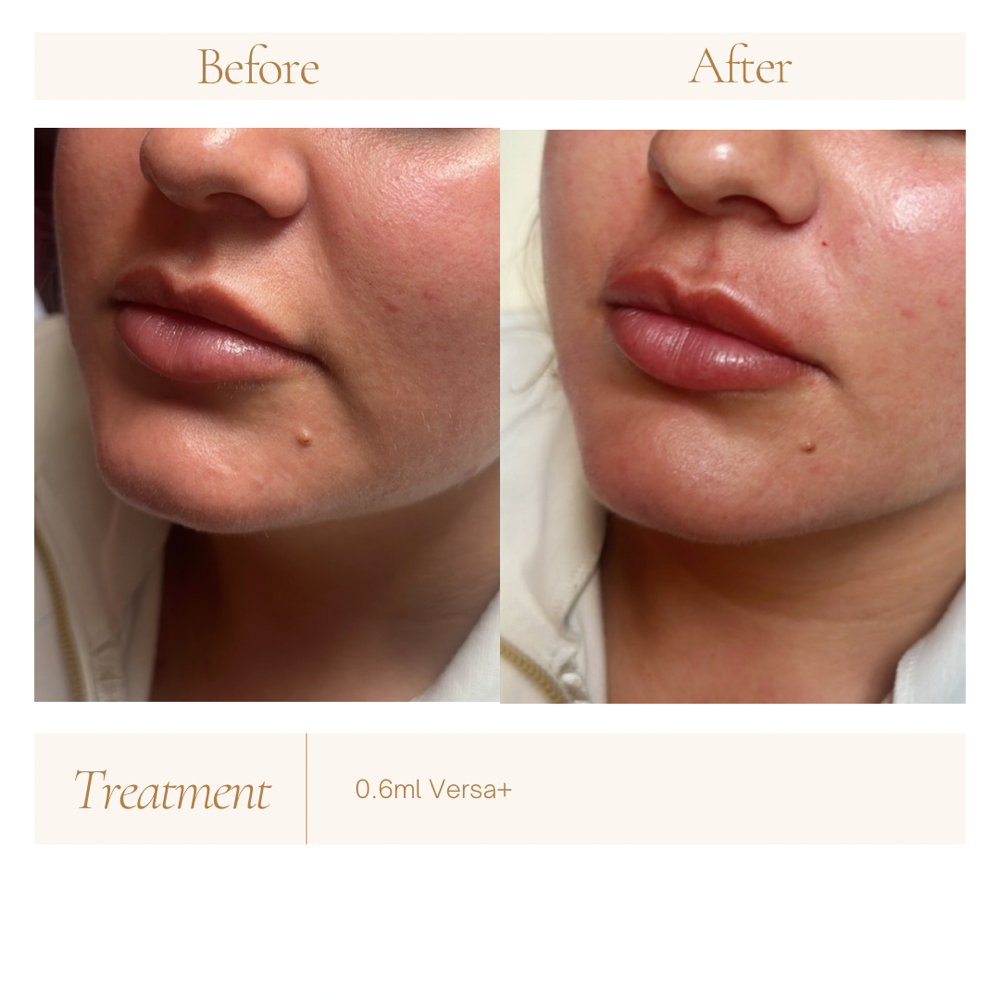 Nasolabial Fold Filler