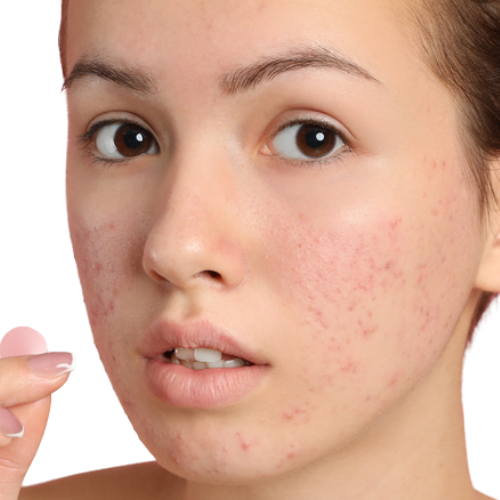 ADVANCED ROSACEA CORRECTION 10-PACK at Star Spa Lash & Brow By: Evelyn Esthetician in Oakland, NJ