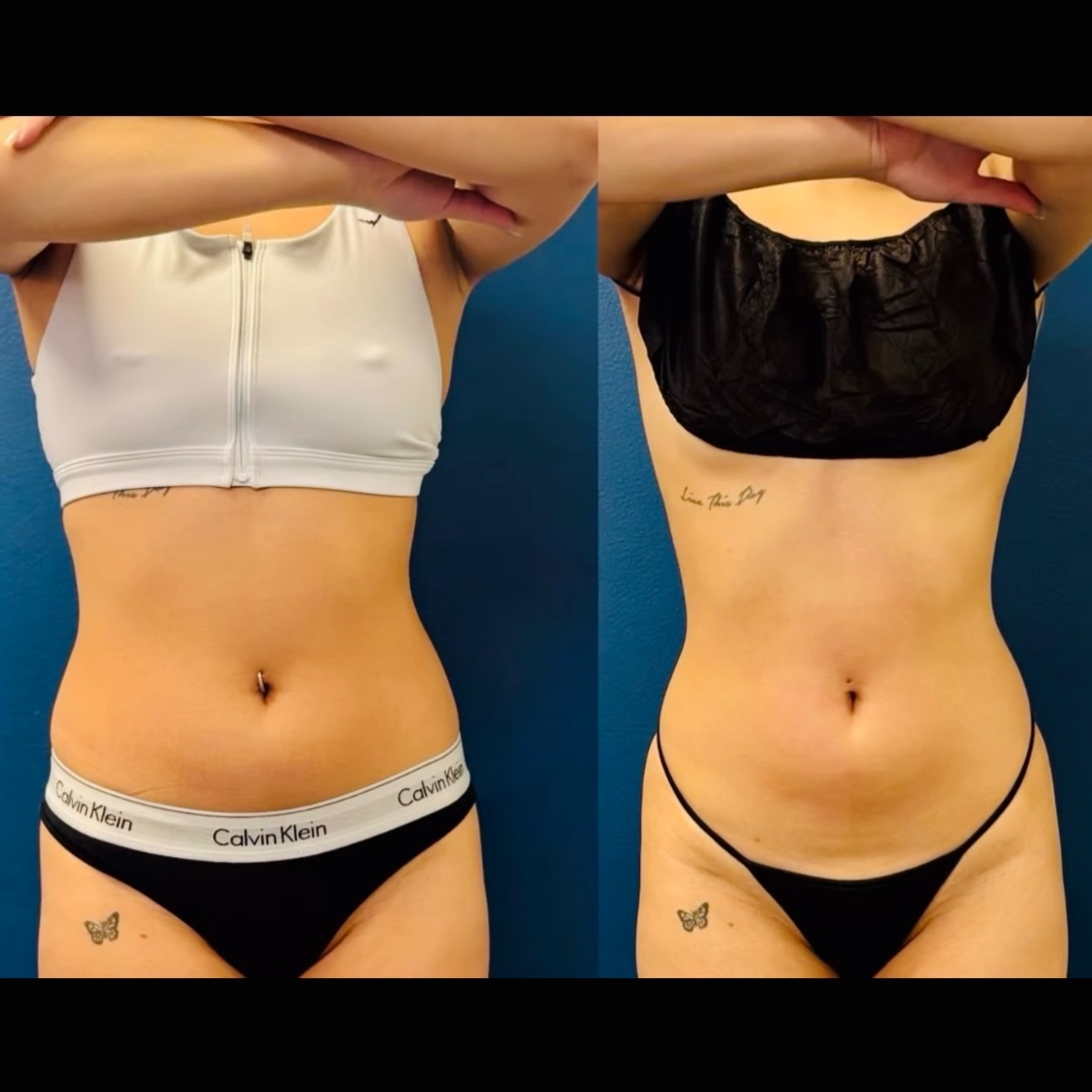 Peptide & Sculpt - Fat Loss Program at BareFruit Body Lab in Alexandria, VA