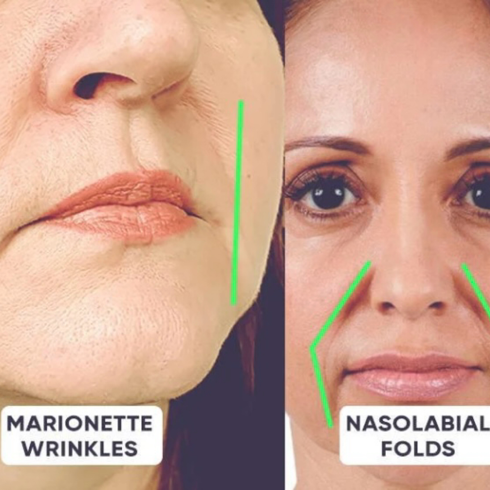 Nasalobial/Marionette Lines Filler at Finesse Sculpt Body Studio in Parkville, MD