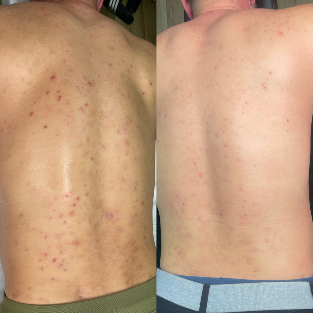 Back Acne Bootcamp