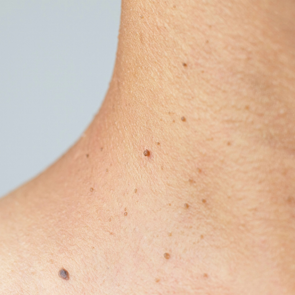 Skin Tag Removal at Beautylosophy Lash & Permanent Makeup in Pearland, TX