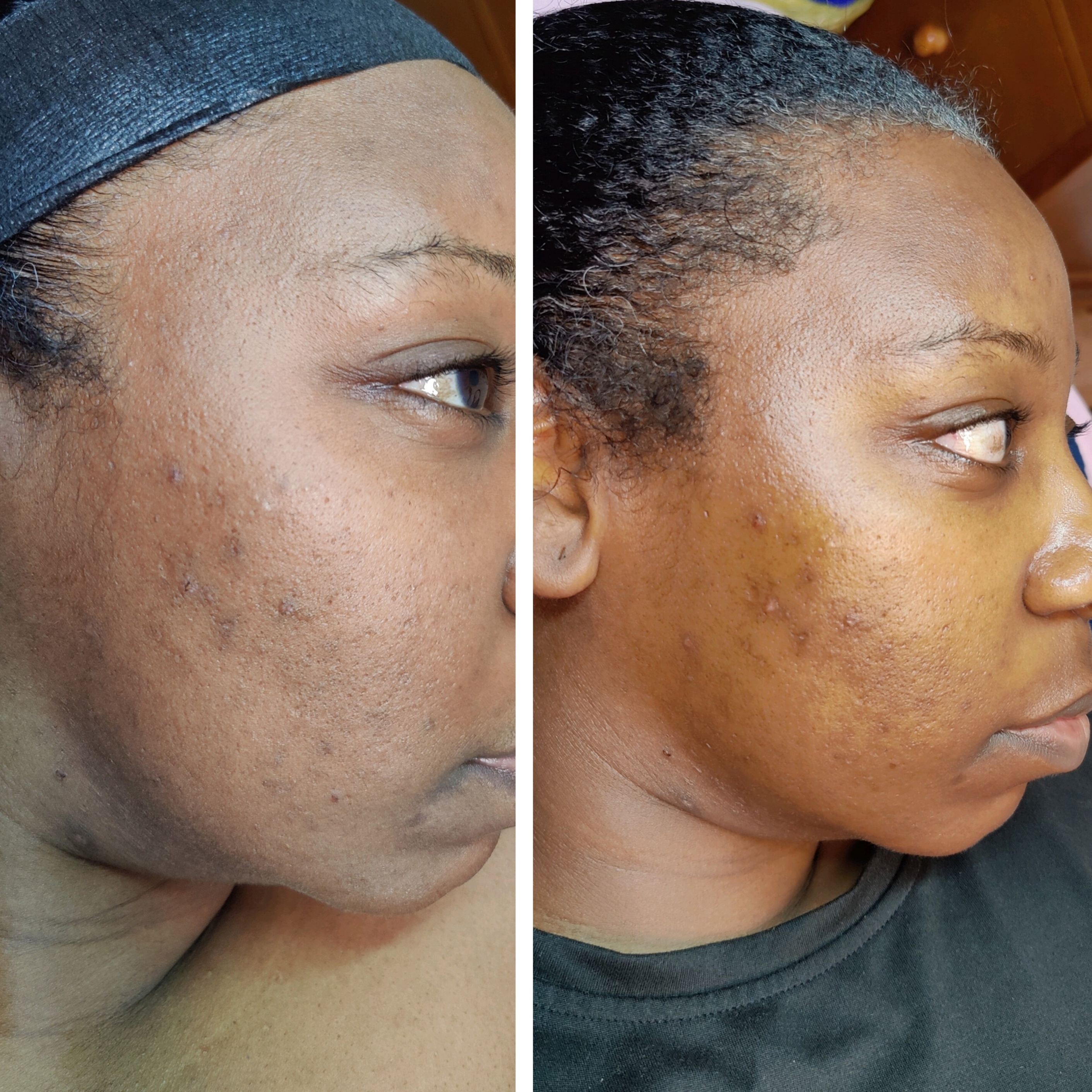 Dermaplane (add on) at Twistykinks & Twist of Elegance Esthetics in Jacksonville, AR