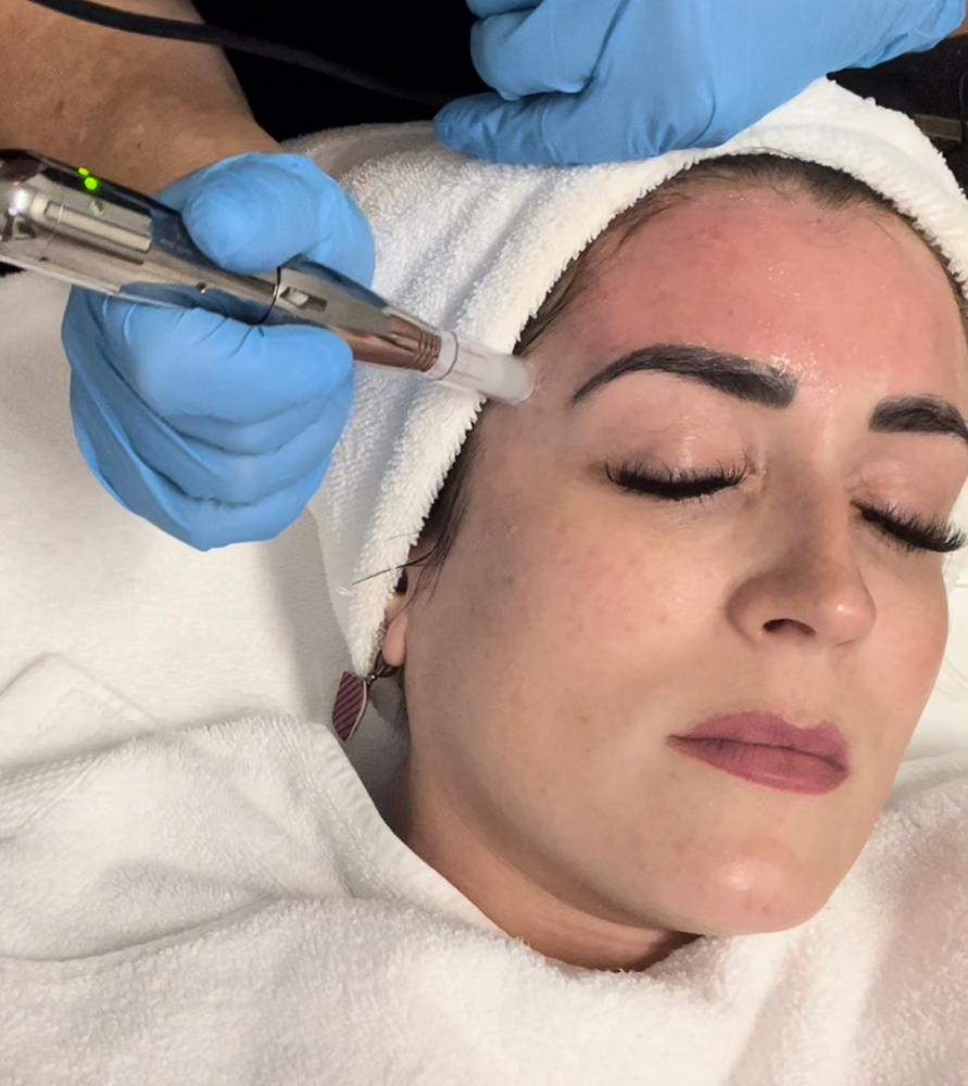 Micro Needling