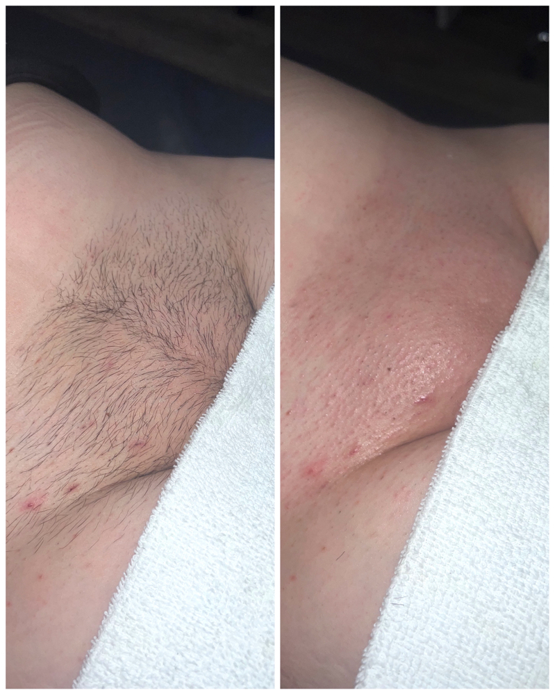 Brazilian Wax
