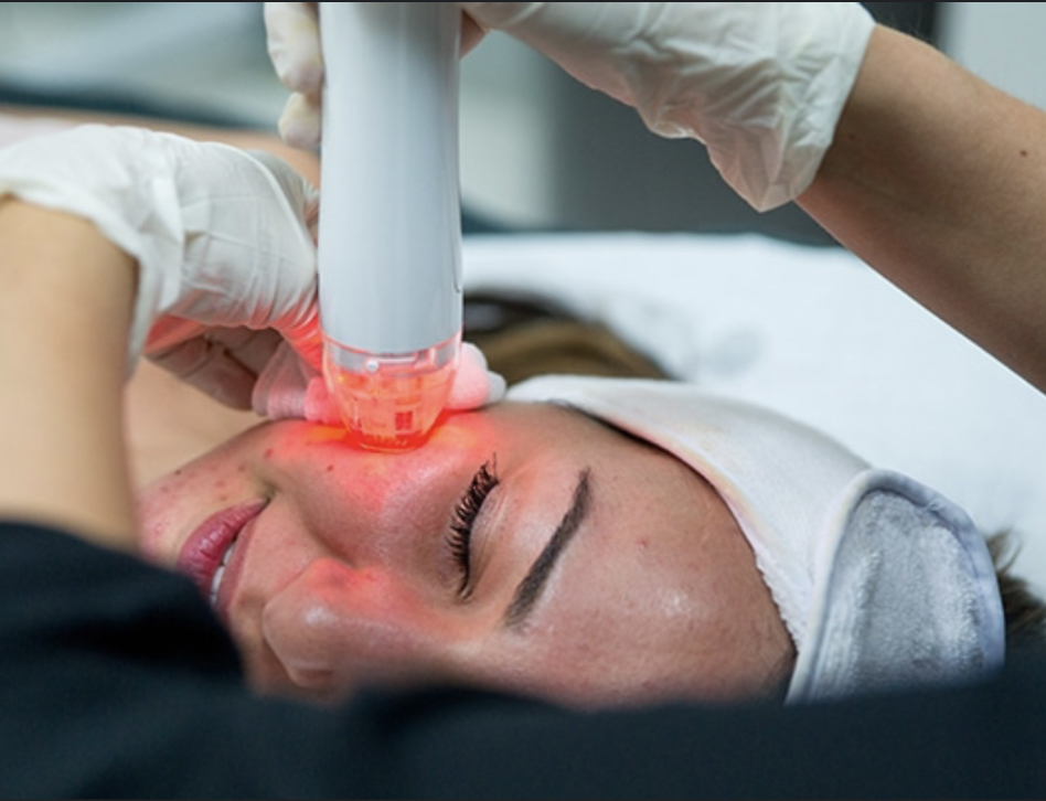 Microneedling Package 3 Treatments