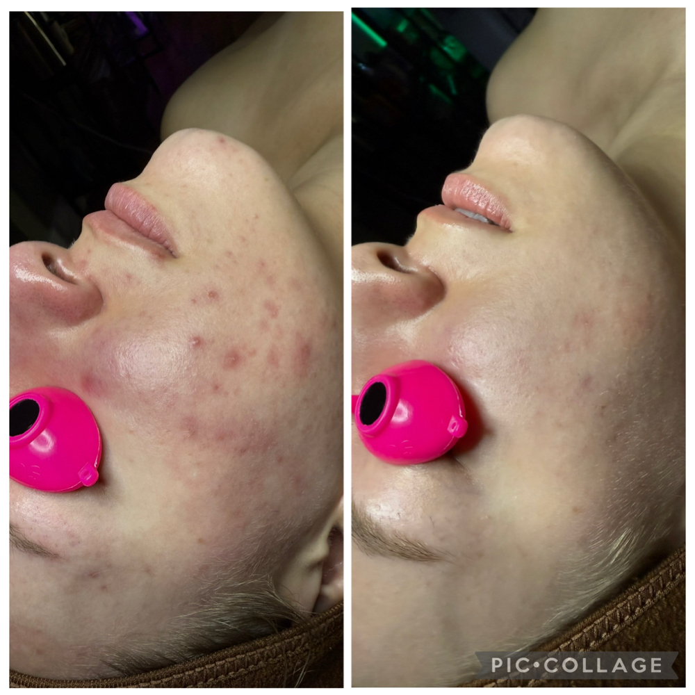 FACE REALITY TREATMENT INTIAL at Eclectic Esthetics in Beech Grove, IN