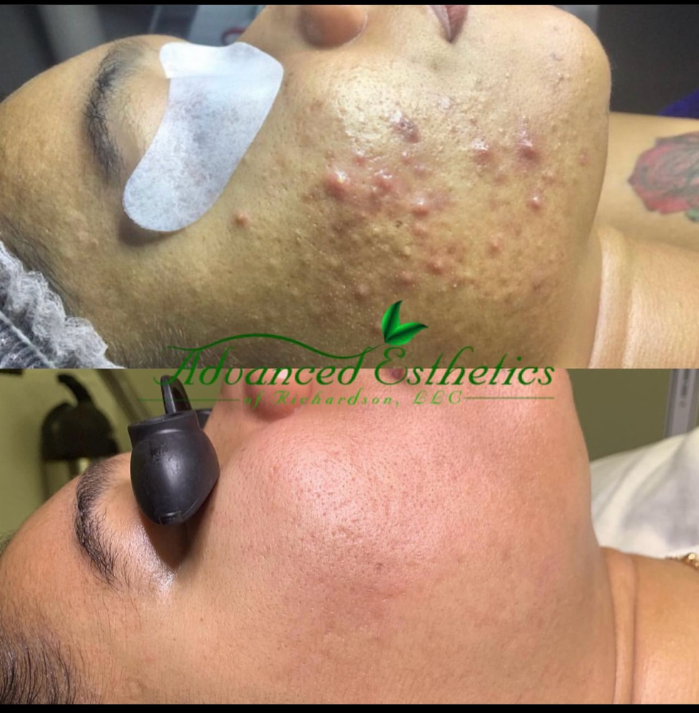 Acne Detox Facial – Clear & Purify