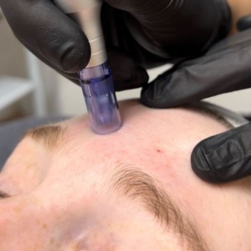 Microneedling + PDRN / SALMON at Lumiee Skincare Llc in Chicago, IL