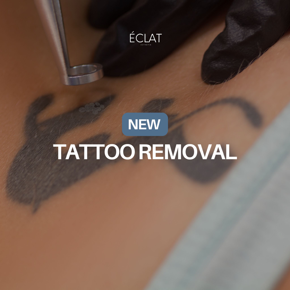 REMOVE TATTOO