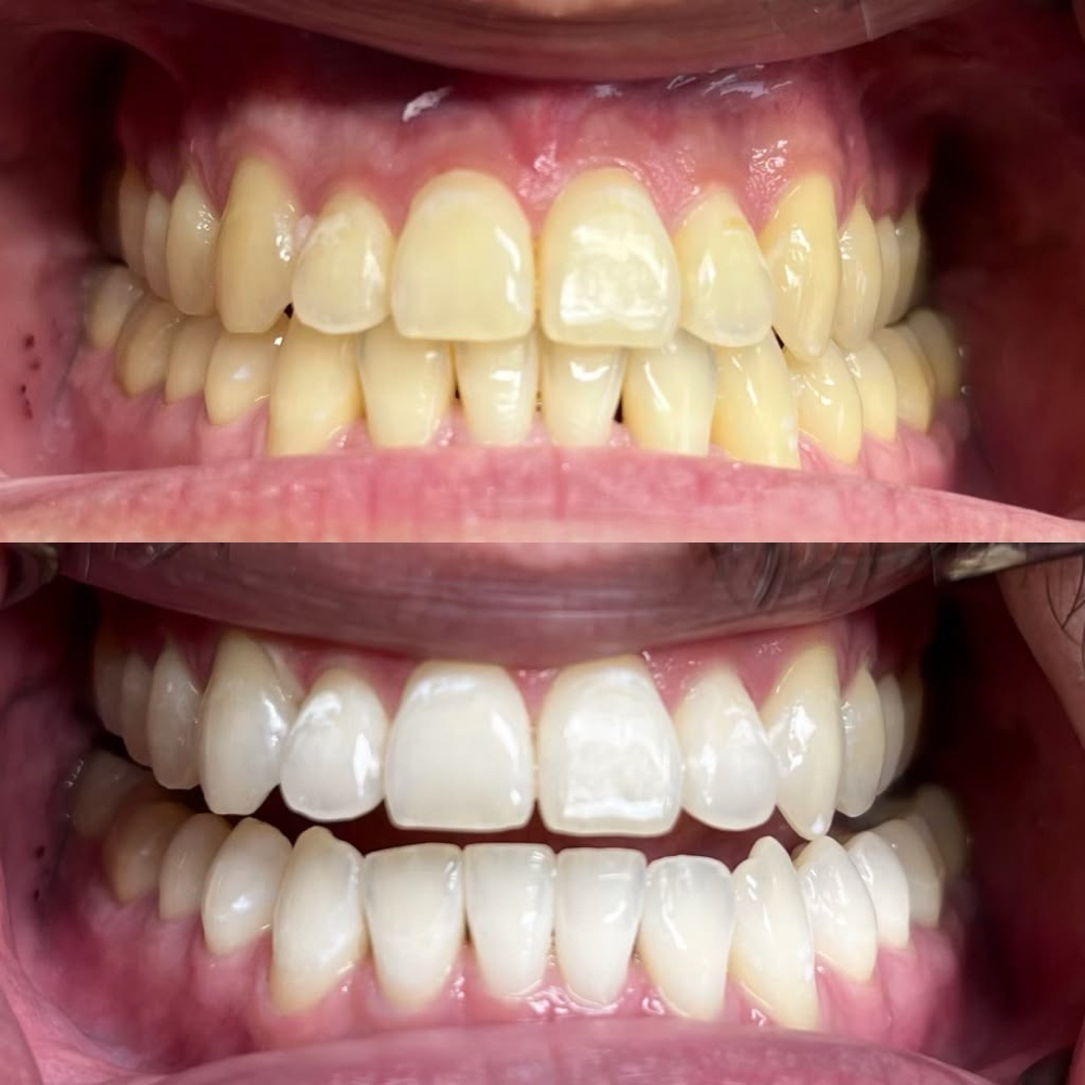 Teeth Whitening at Pearl Esthetics in Pasadena, TX