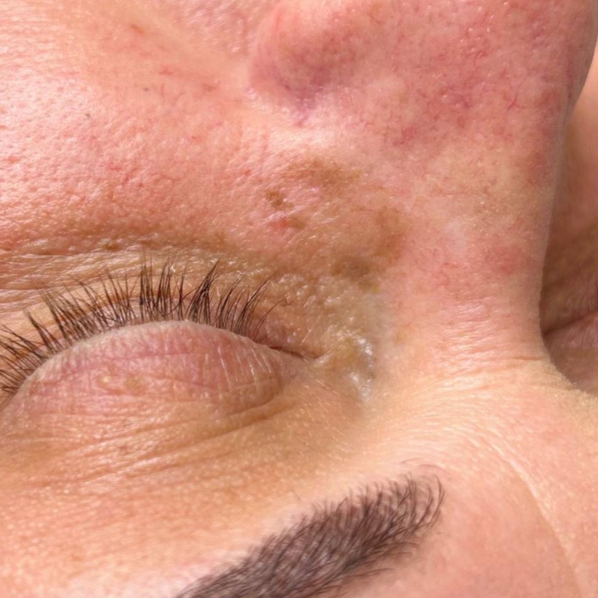 Small Pigmentation Removal (1 inch) at Beauty Pro in Nixa, MO