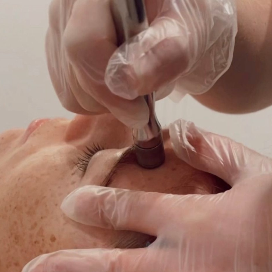 Microdermabrasion Add On