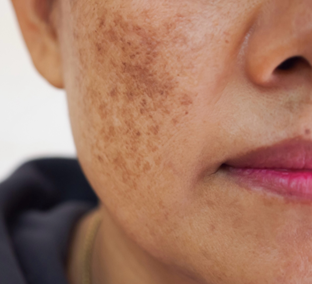 Tratamento De Melasma ( Avaliação)