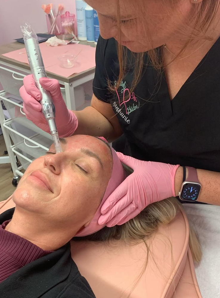 Microneedling With PRP