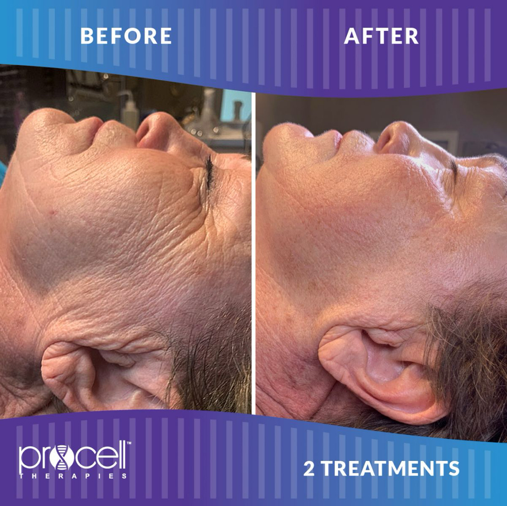 Procell Treatment