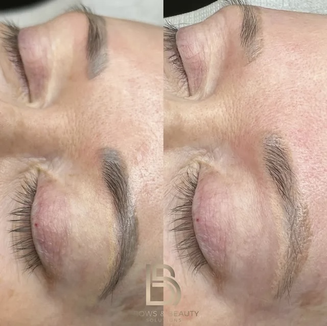 Cosmetic Tattoo Removal