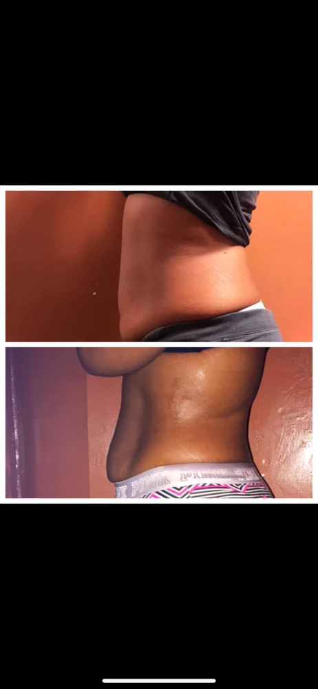Stomach Cavitation