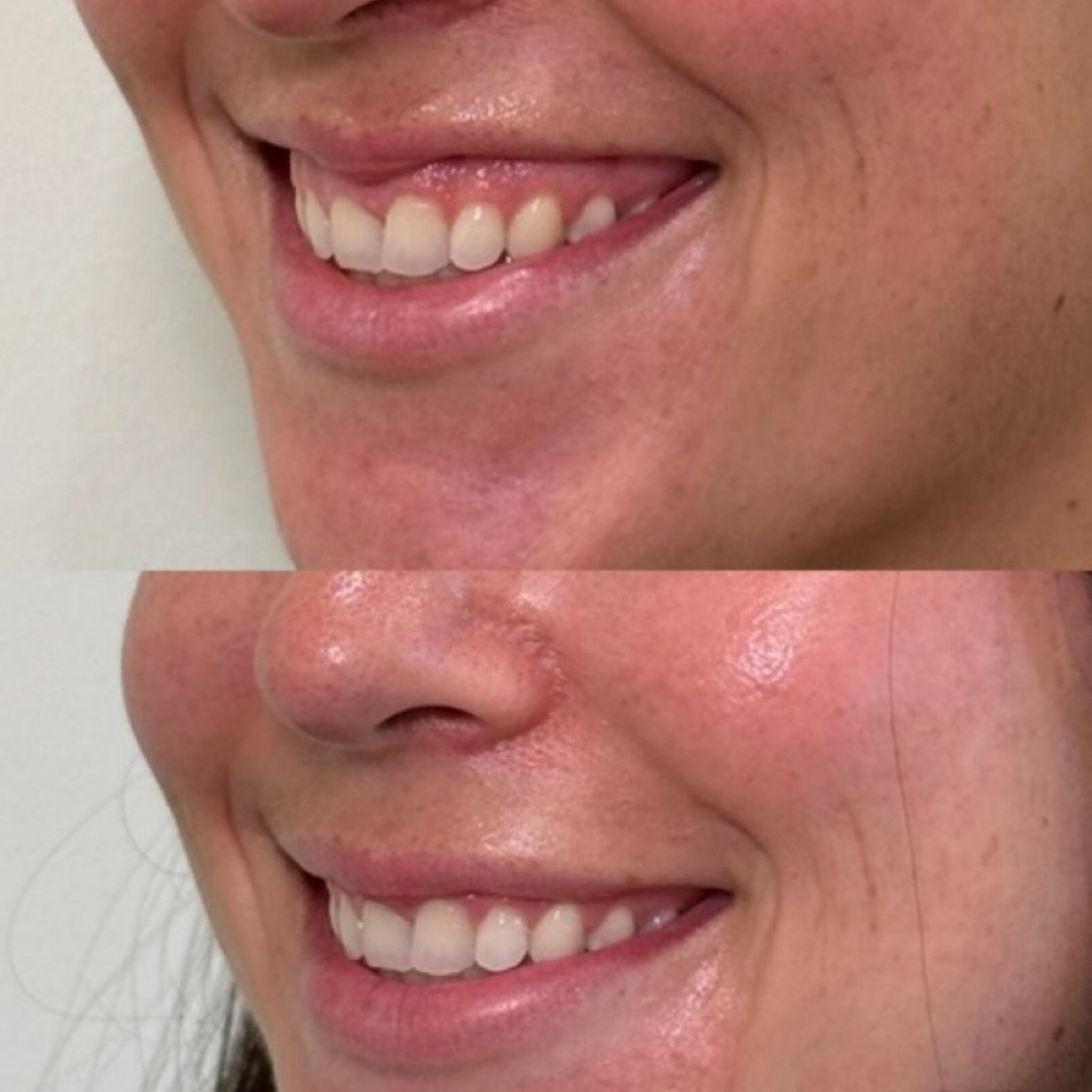 Lip Flip at Lilli Aesthetics LLC in Mansfield, TX