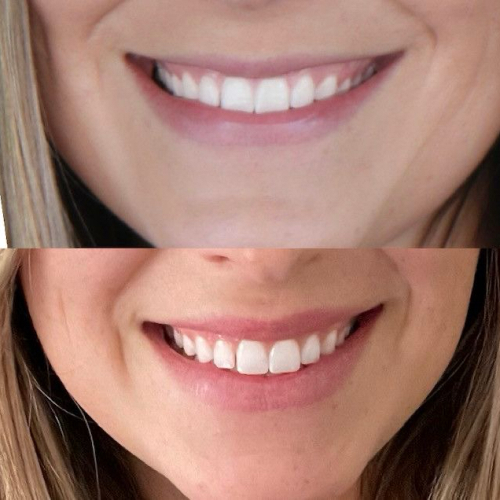 Lip Flip at Lilli Aesthetics LLC in Mansfield, TX