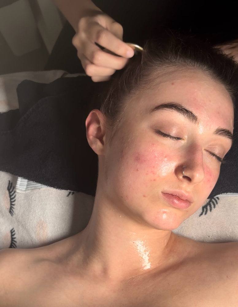 Chemical Peel Add On