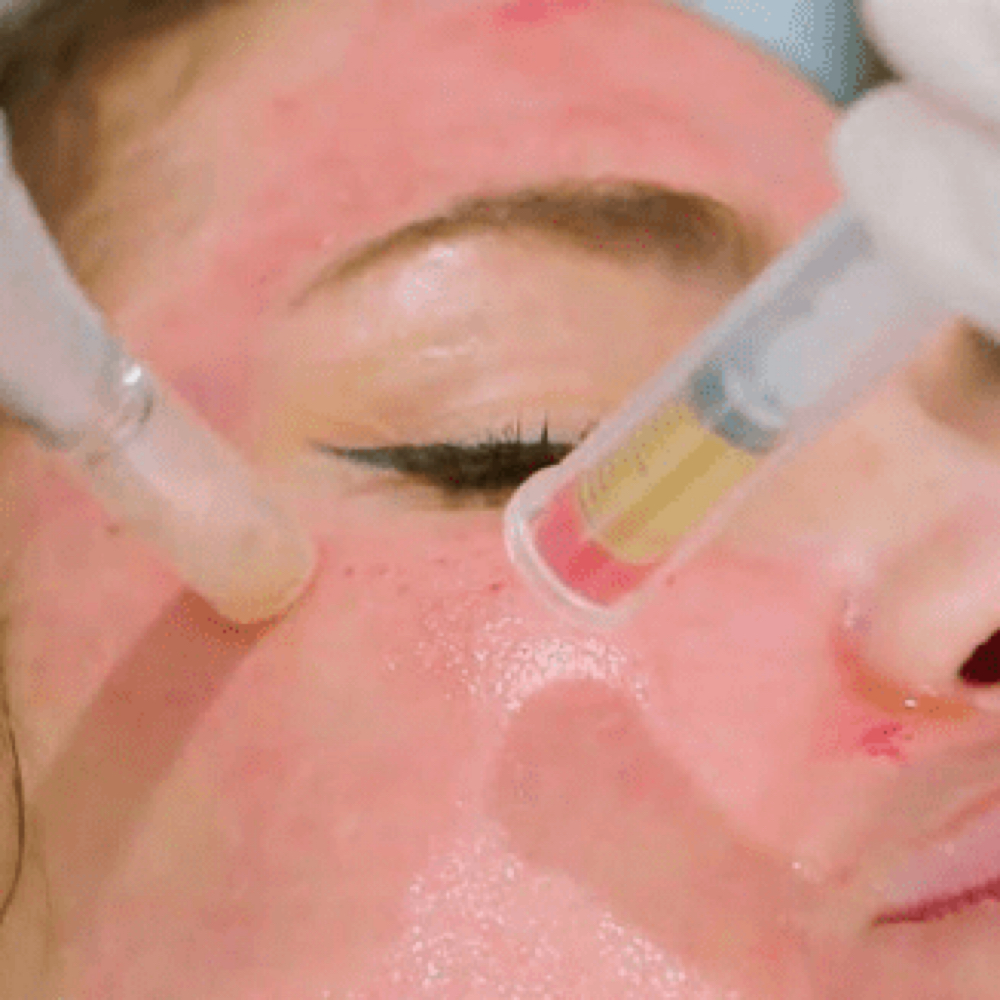 PRP Microneedling - Vampire Facial at Dawn Esthetics in Colorado Springs, CO