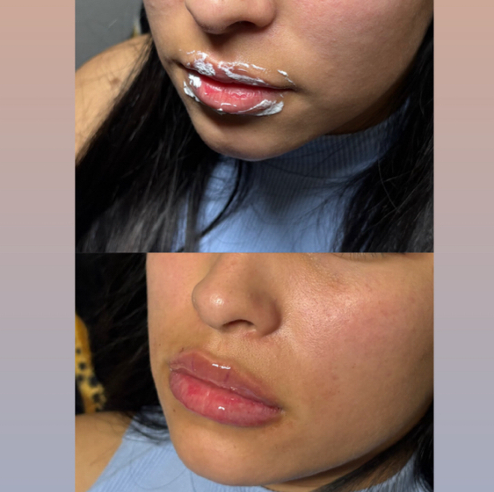 Lip Filler 1ML at Studios Secrets in Dallas, TX