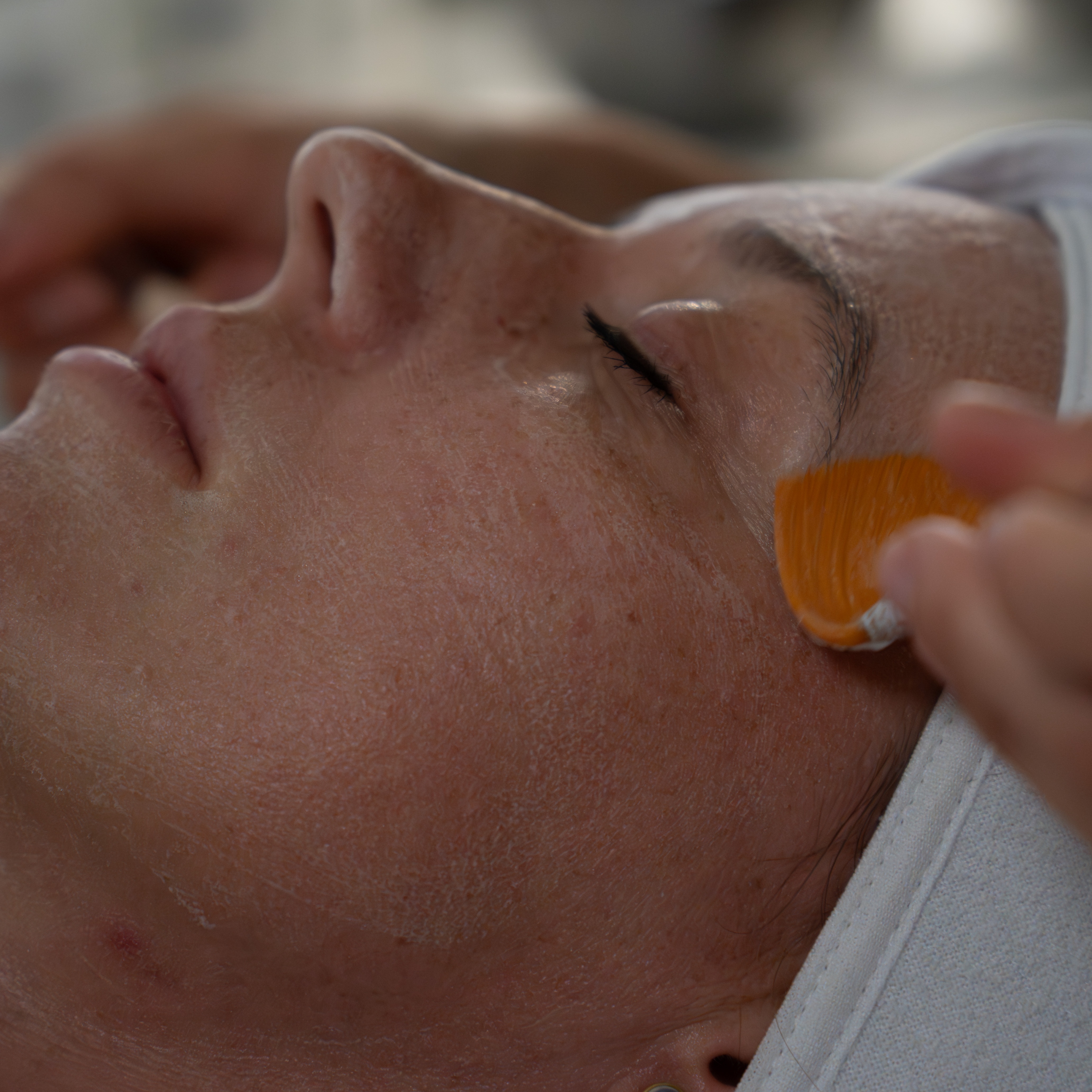 Chemical Peel | Simildiet (Spain)