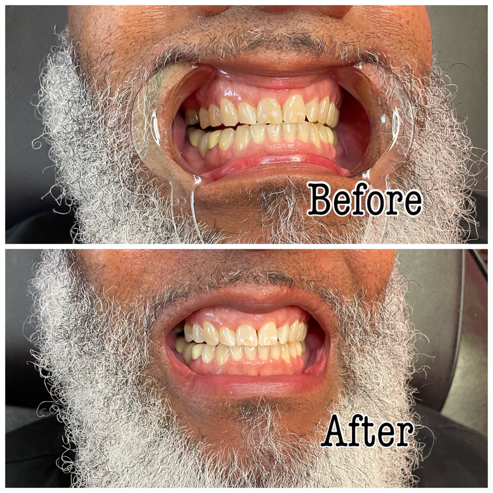 Teeth Whitening