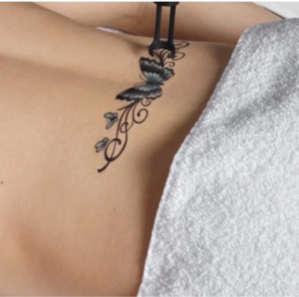 Tattoo Removal MD - Unlimited at NICHÉ in Lewisville, TX