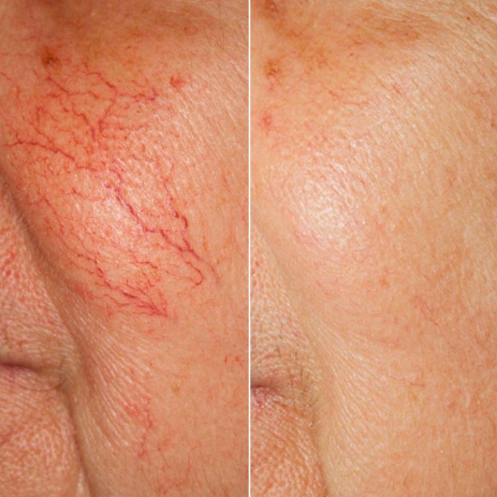 Vascular Veins at La Belle Studio by Soraya in Woburn, MA