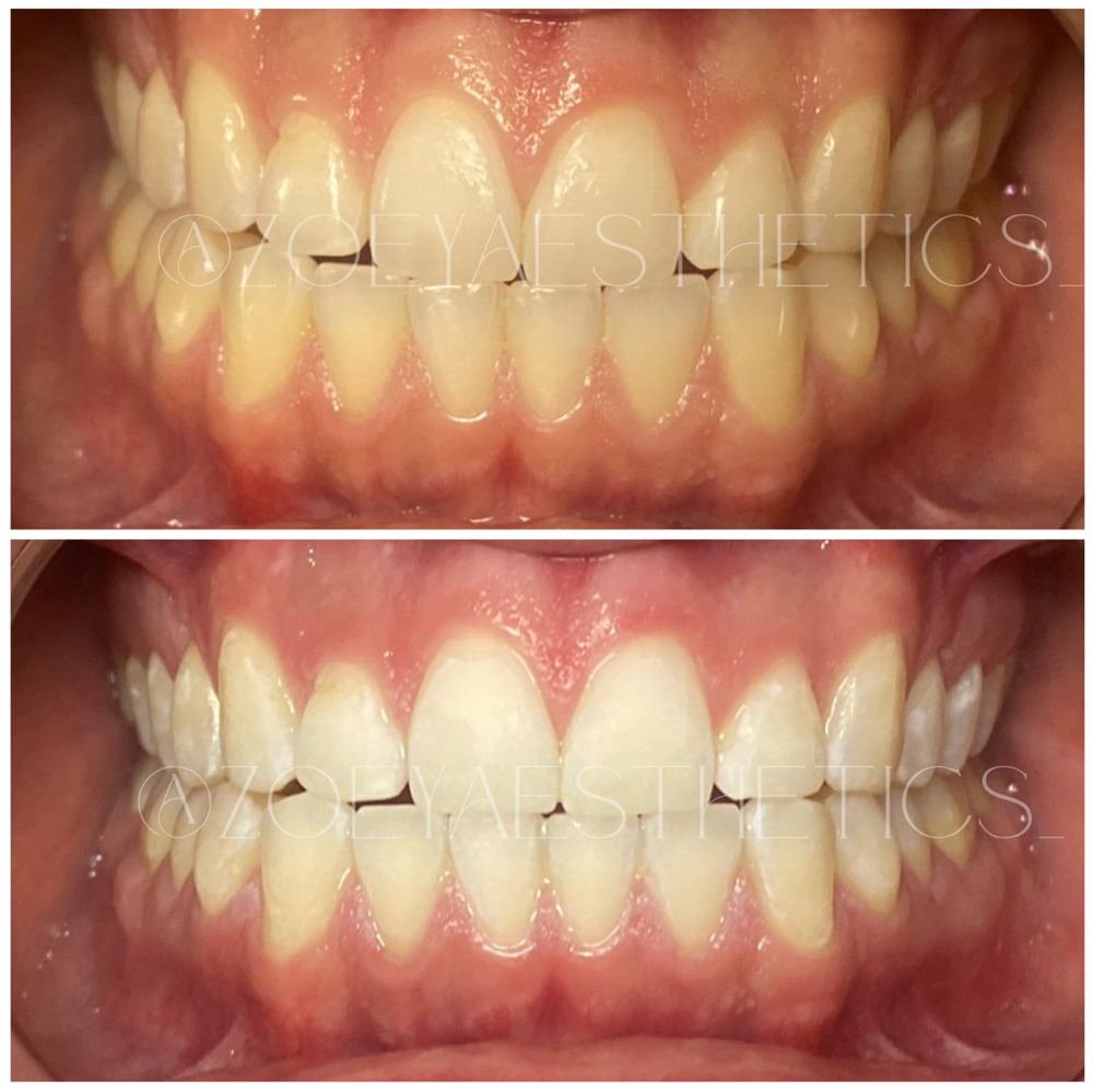 40 Minute Whitening Session