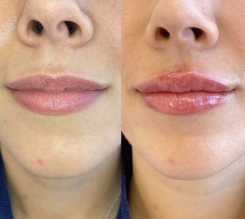 Hyaluronic Acid Lip Injections